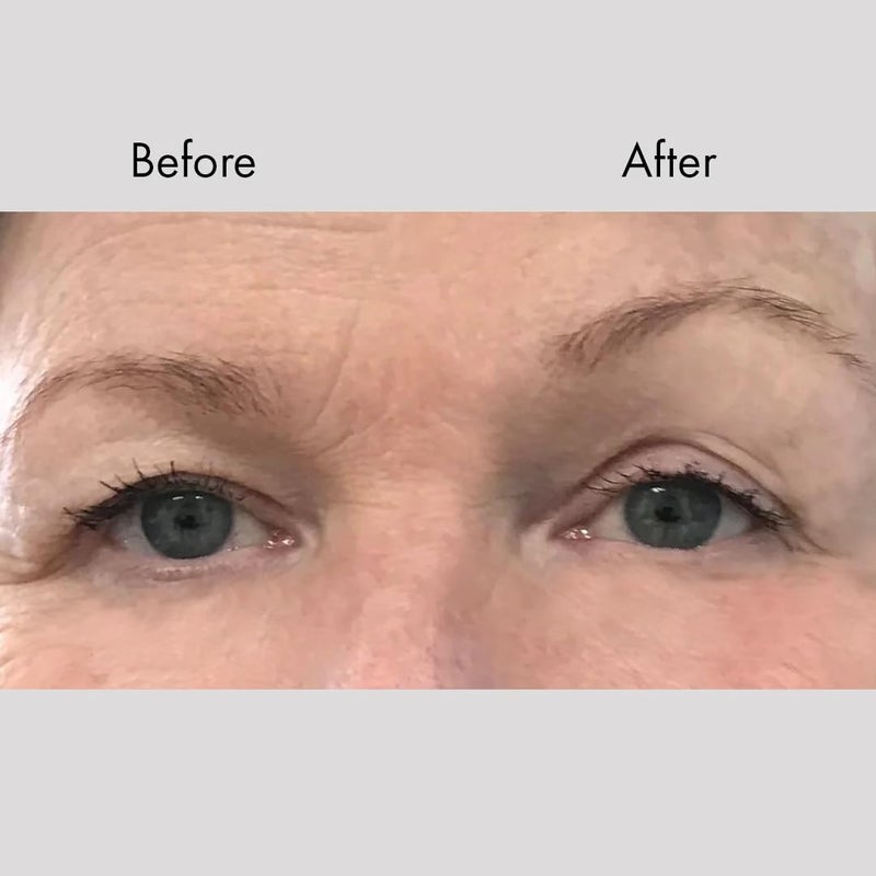 Bring It Up Instant Browlifts - Eyebrow Lift Strips, Anti-Wrinkle Tape/Stickers- 30 Days Supply - Image 3